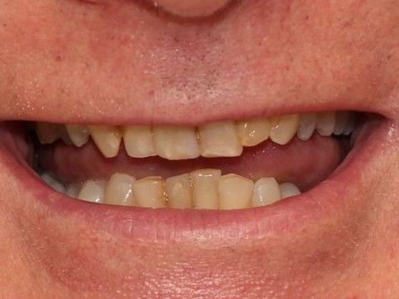 Before Dental Crowns